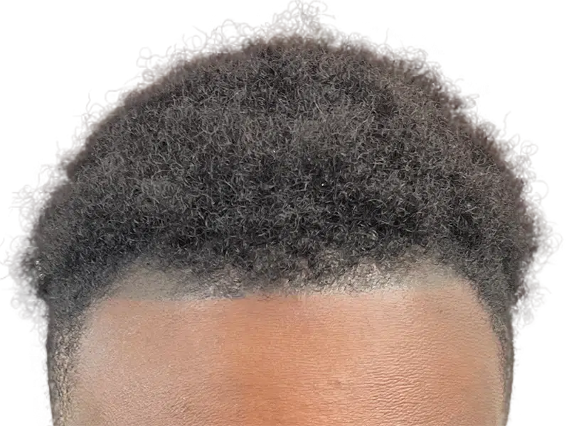 Natural hairline. Hair restoration result? Dark, curly hair. No visible transplant signs. Before/After potential.