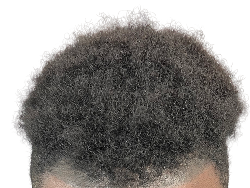 Dense, dark curly hair. Potential hair restoration candidate. Before hair transplant assessment.