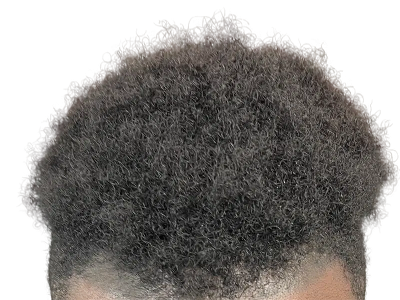 Dense, dark curly hair. Potential hair restoration candidate. Before hair transplant assessment.