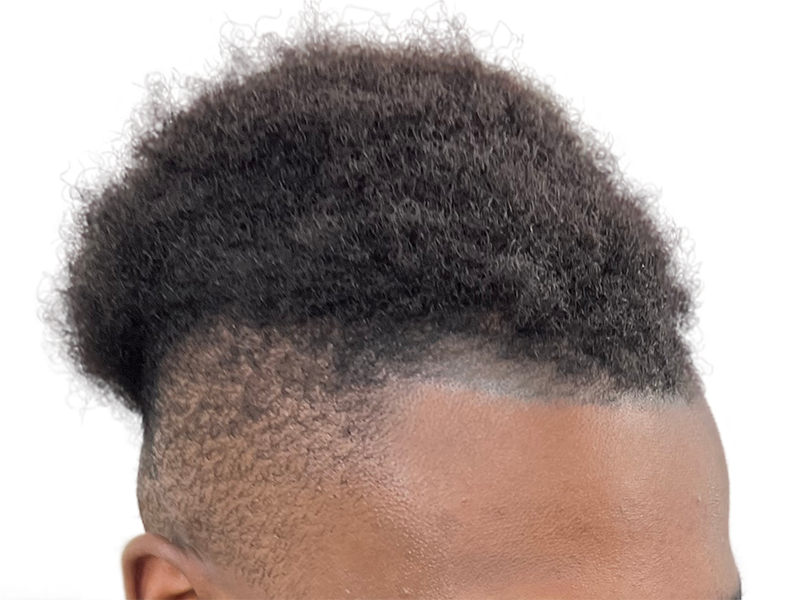 Hair transplant result on African American man. Before/after showing denser top hair and restored hairline. Hair restoration.