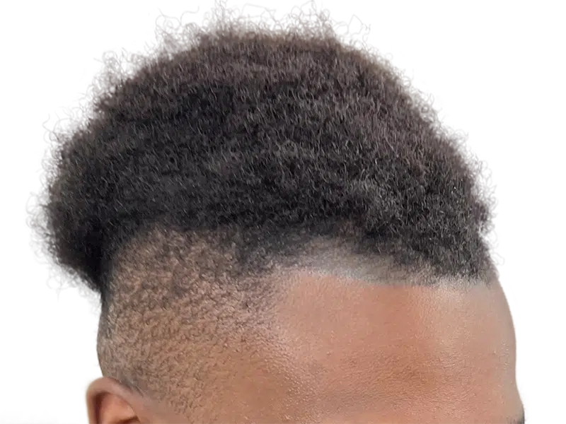 Hair transplant result on African American man. Before/after showing denser top hair and restored hairline. Hair restoration.