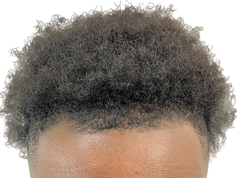 African American hairline. Dense, natural curls. No hair transplant visible. Hair restoration potential.
