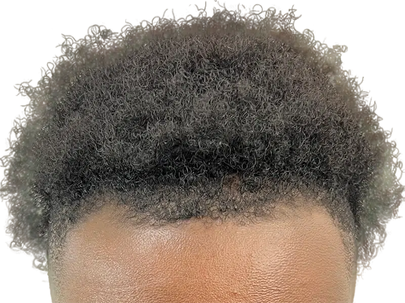 African American hairline. Dense, natural curls. No hair transplant visible. Hair restoration potential.