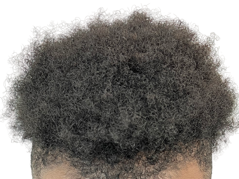 Dense, natural-looking dark hair. Potential hair restoration results. No visible transplant evidence. Healthy hair.