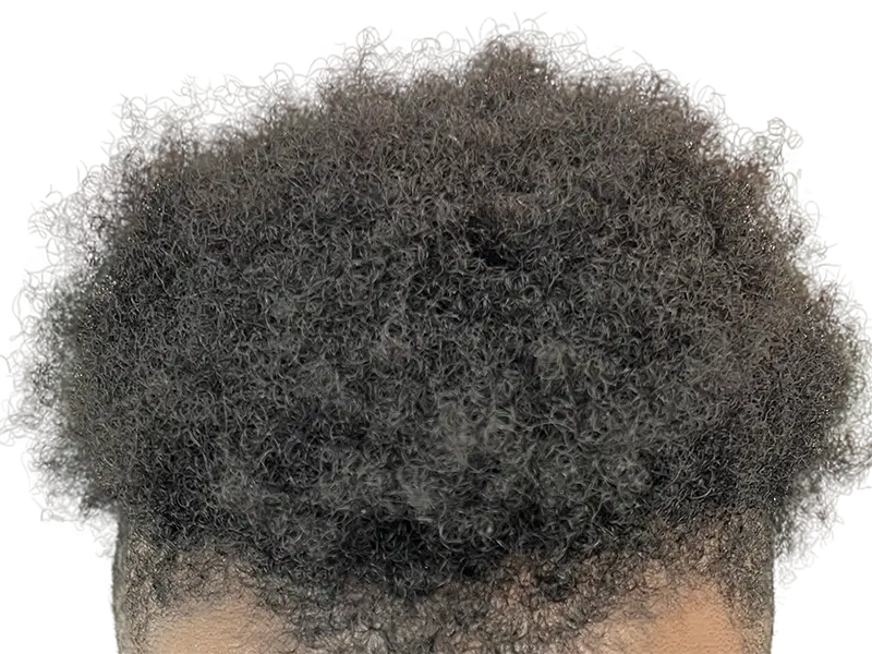 Dense, natural-looking dark hair. Potential hair restoration results. No visible transplant evidence. Healthy hair.