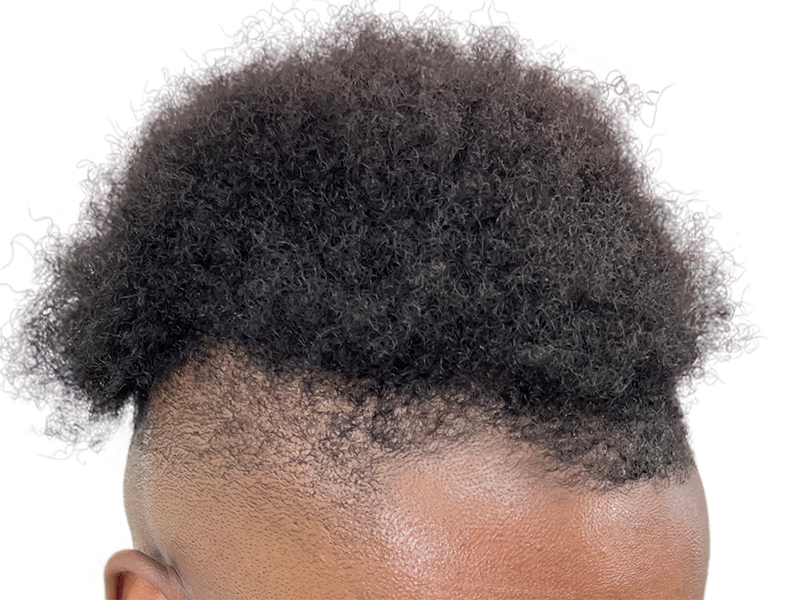 Thick, curly African American hair. Potential hair restoration candidate. Scalp visible on shaved sides. Before treatment.