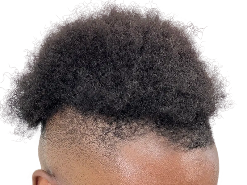 Thick, curly African American hair. Potential hair restoration candidate. Scalp visible on shaved sides. Before treatment.