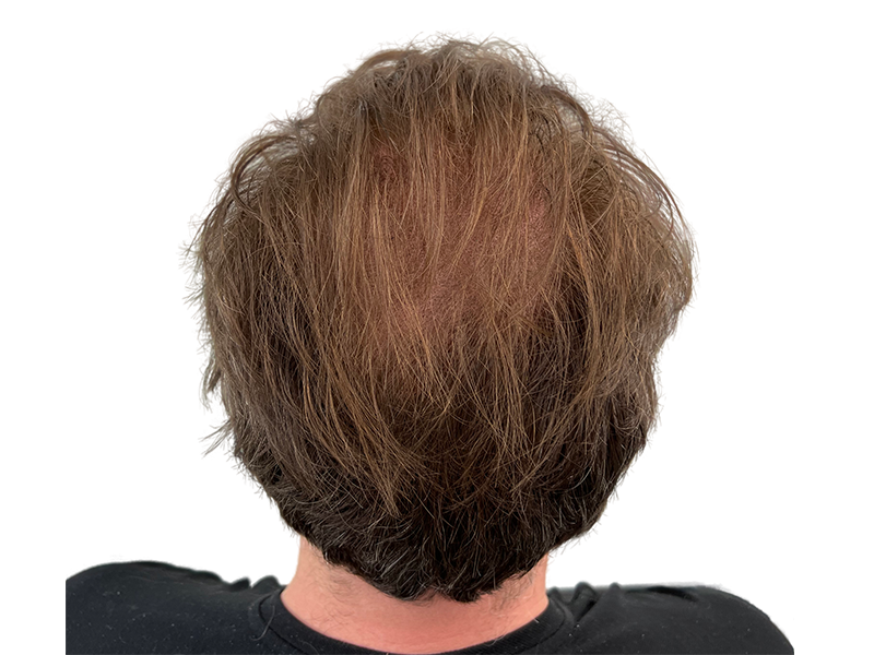 Thinning brown hair (back view). Potential hair restoration candidate. No transplant visible.