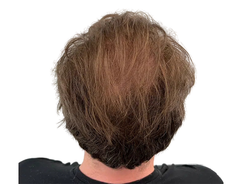 Thinning brown hair (back view). Potential hair restoration candidate. No transplant visible.