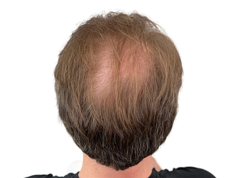 Thinning hair on crown. Hair restoration or transplant consult? Before/after results may vary. Light brown hair with gray.