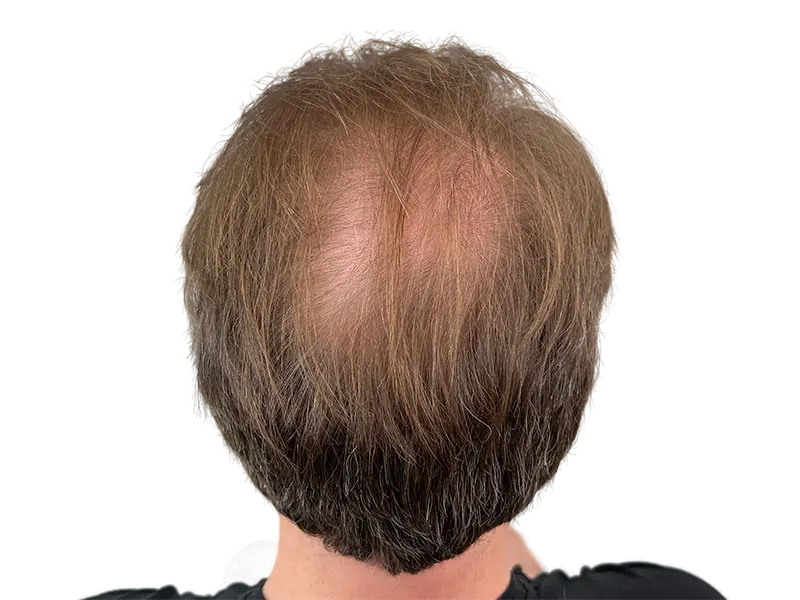 Thinning hair on crown. Hair restoration or transplant consult? Before/after results may vary. Light brown hair with gray.