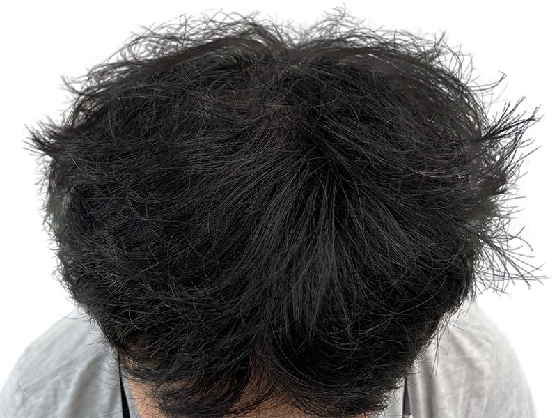 Before hair restoration: Dense, dark hair with some gray. Possible hair transplant candidate. Overhead view.