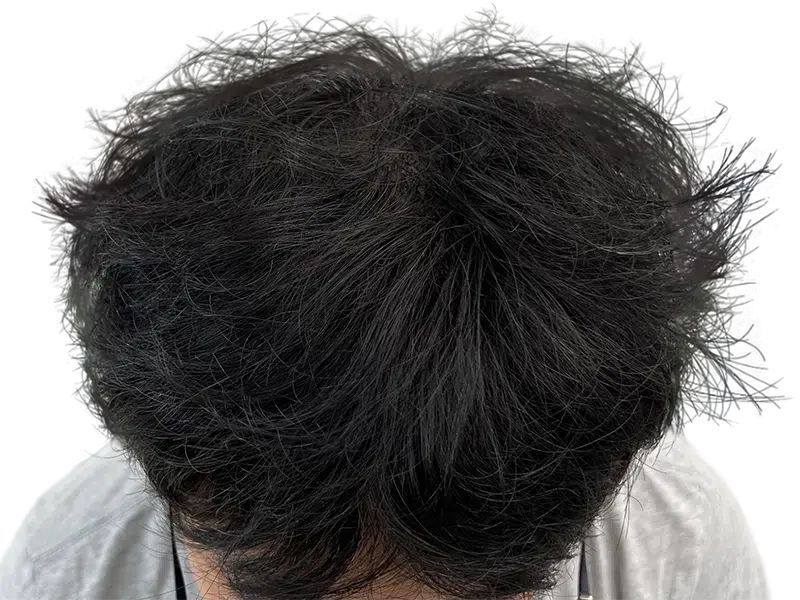 Before hair restoration: Dense, dark hair with some gray. Possible hair transplant candidate. Overhead view.