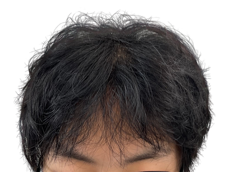 Thinning dark hair at crown. Possible before/after hair transplant. Hair restoration services available.