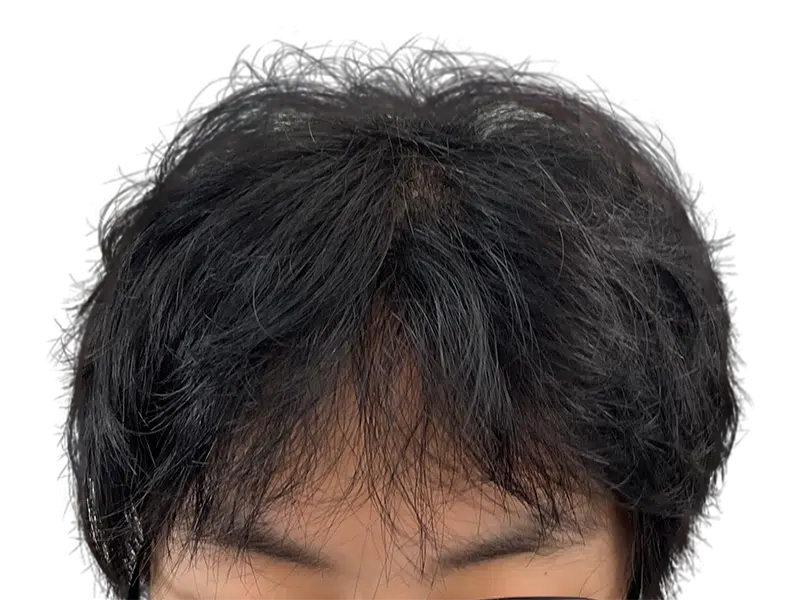 Thinning dark hair at crown. Possible before/after hair transplant. Hair restoration services available.