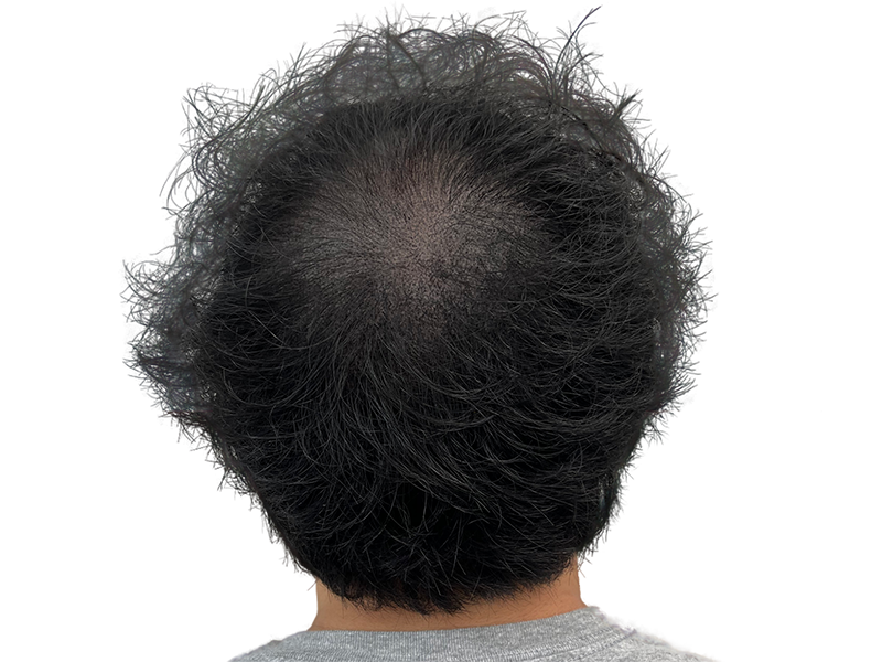 Thinning dark hair at the crown. Hair loss example for hair restoration or transplant consideration.