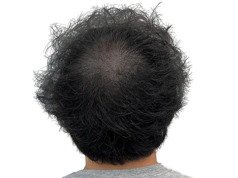 Thinning dark hair at the crown. Hair loss example for hair restoration or transplant consideration.