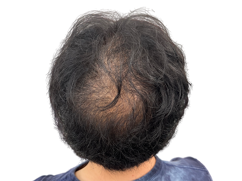 Thinning dark hair at the crown. Potential hair transplant candidate. Consult for hair restoration options.