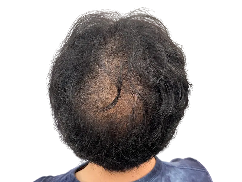 Thinning dark hair at the crown. Potential hair transplant candidate. Consult for hair restoration options.