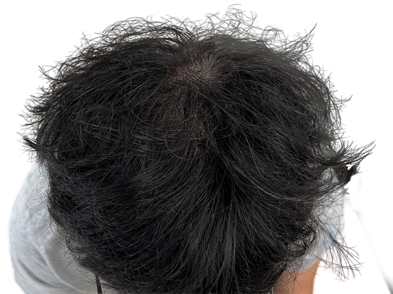 Thinning dark hair at the crown. Potential hair transplant candidate. Before/after comparison for hair restoration results.