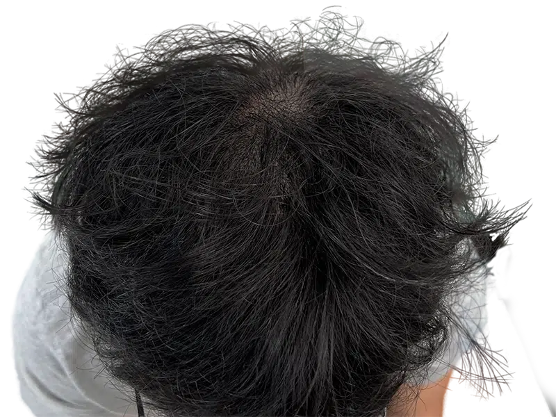 Thinning dark hair at the crown. Potential hair transplant candidate. Before/after comparison for hair restoration results.