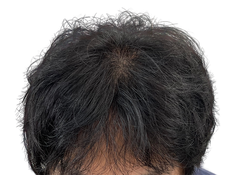 Thinning hair at crown. Potential hair transplant candidate. Hair restoration before/after assessment possible.