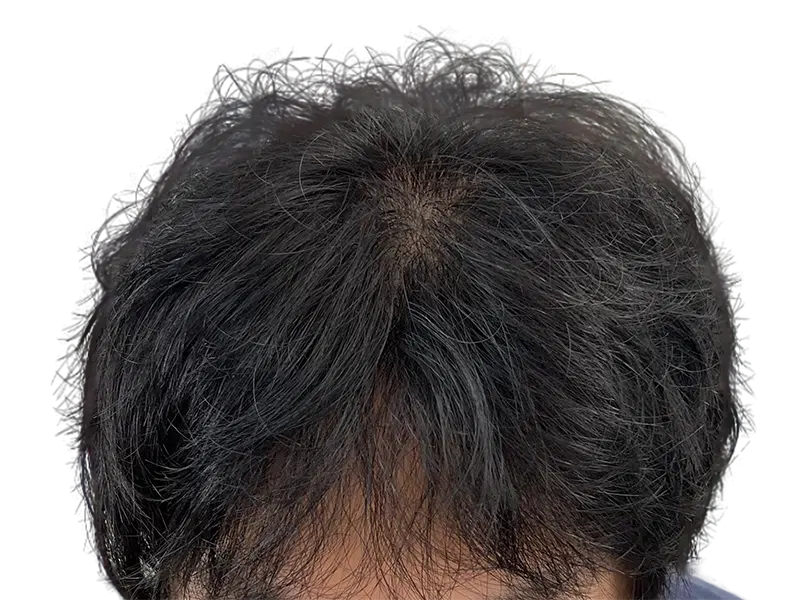 Thinning hair at crown. Potential hair transplant candidate. Hair restoration before/after assessment possible.