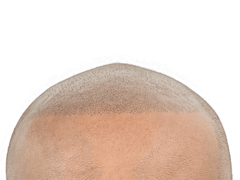 Hair transplant result: denser hairline achieved. Before & after showing improved hair density. Hair restoration success.