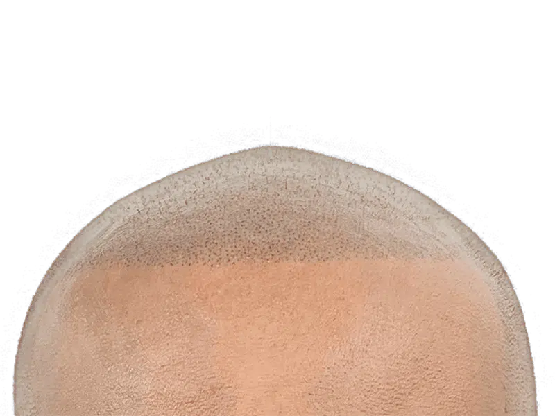 Hair transplant result: denser hairline achieved. Before & after showing improved hair density. Hair restoration success.