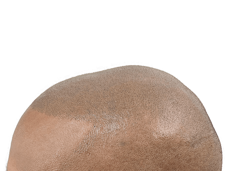 Hair transplant result: Close-up of scalp showing transplanted follicles. Light brown skin. Hair restoration procedure.