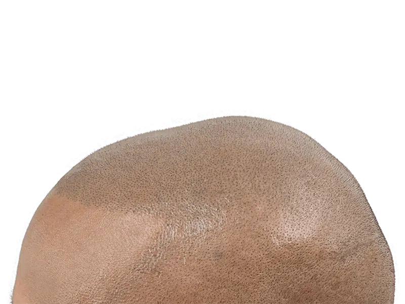 Hair transplant result: Close-up of scalp showing transplanted follicles. Light brown skin. Hair restoration procedure.