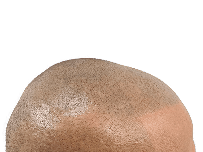 Hair transplant after: Close-up of restored hairline. Natural, even hair density. Hair restoration success.