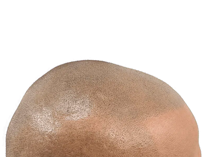 Hair transplant after: Close-up of restored hairline. Natural, even hair density. Hair restoration success.