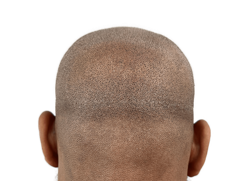 Hair transplant result: Dense, even hair restoration on African American/Hispanic man. Natural hairline achieved.