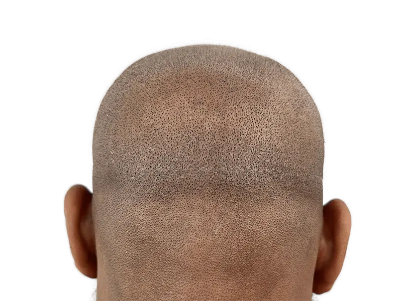 Hair transplant result: Dense, even hair restoration on African American/Hispanic man. Natural hairline achieved.