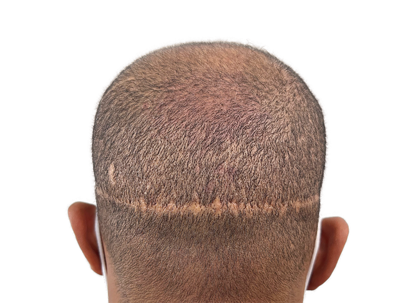 Hair transplant scar on back of head. Hair restoration result showing denser hair growth above scar. Before & after hair density.