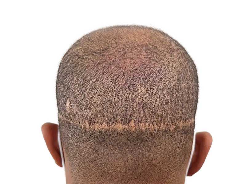 Hair transplant scar on back of head. Hair restoration result showing denser hair growth above scar. Before & after hair density.