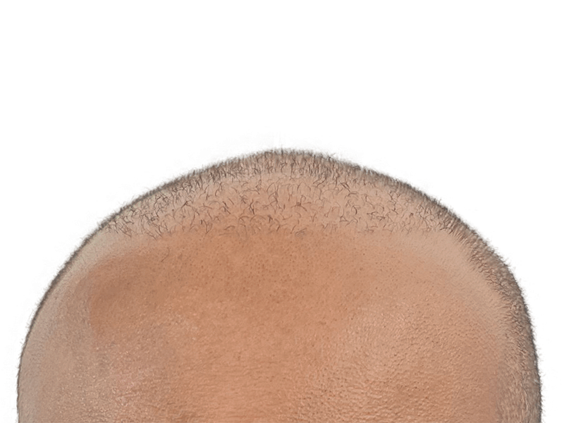 Balding head: potential hair loss before hair restoration or transplant. See possible results.