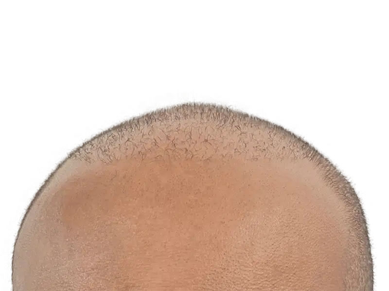 Balding head: potential hair loss before hair restoration or transplant. See possible results.