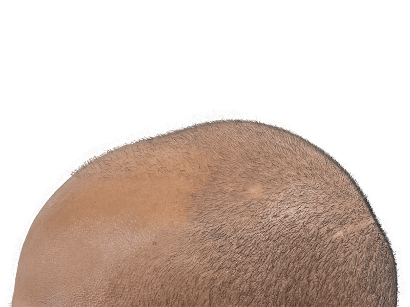Hair transplant result: Evenly distributed light brown hair on scalp. Possible hair restoration success. Before/after unavailable.