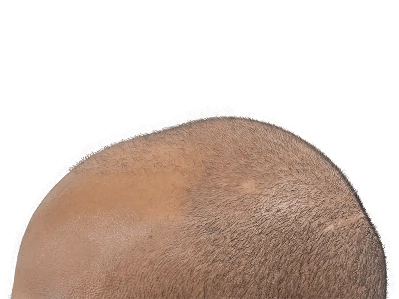 Hair transplant result: Evenly distributed light brown hair on scalp. Possible hair restoration success. Before/after unavailable.