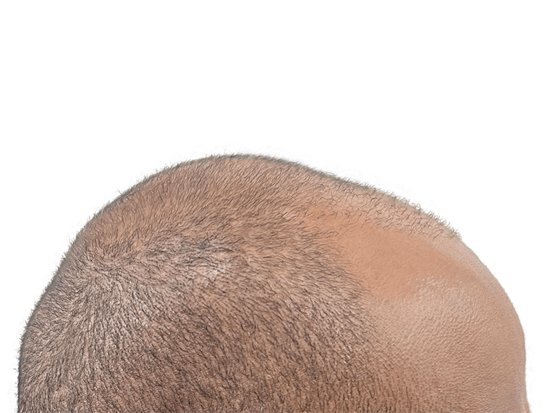 Thinning gray hair on a Caucasian man's head. Potential hair loss candidate. Consider hair restoration options.