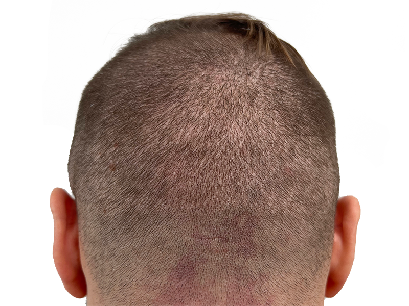 Hair transplant result: Thinning crown restored. Before & after example of hair restoration procedure on male patient.
