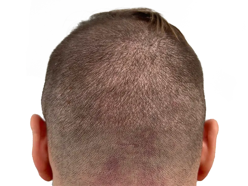 Hair transplant result: Thinning crown restored. Before & after example of hair restoration procedure on male patient.
