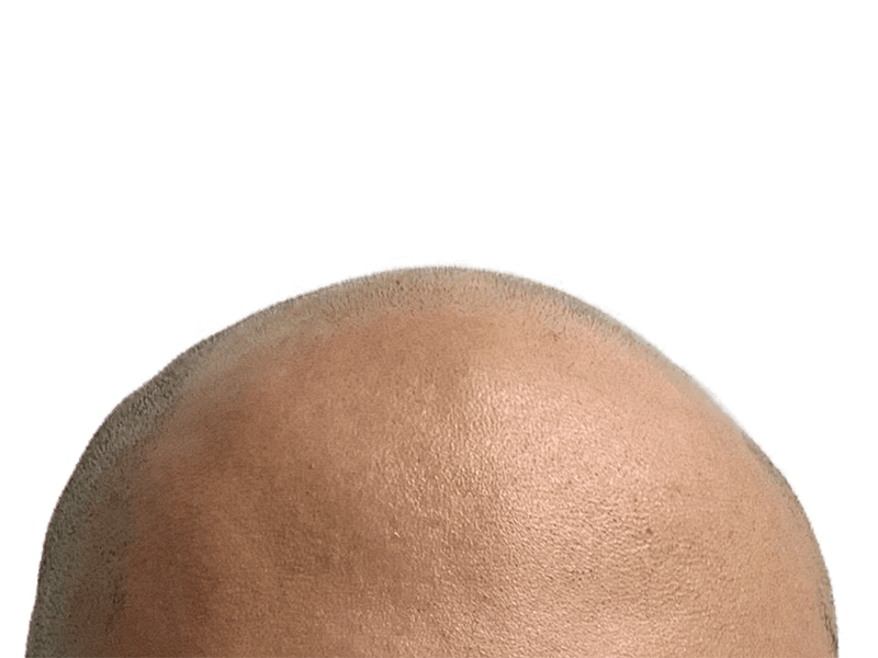 Bald scalp before hair restoration. Shows smooth, hairless skin. Hair transplant consultation image.