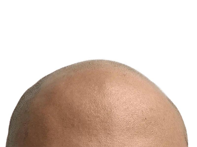 Bald scalp before hair restoration. Shows smooth, hairless skin. Hair transplant consultation image.