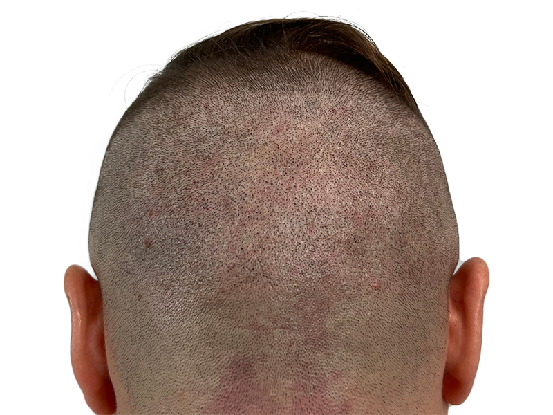 Scalp close-up: Hair transplant recipient. Showing follicle visibility post-procedure. Hair restoration progress.