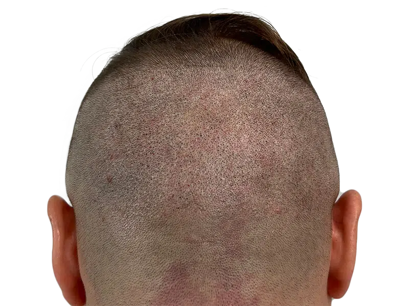 Scalp close-up: Hair transplant recipient. Showing follicle visibility post-procedure. Hair restoration progress.