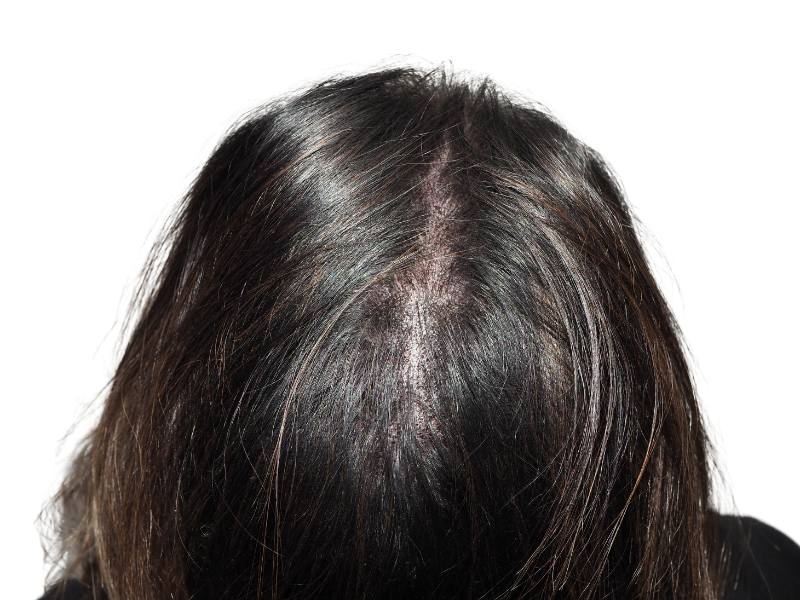 Thinning dark brown hair, visible scalp. Potential hair loss candidate. Consider hair restoration options.