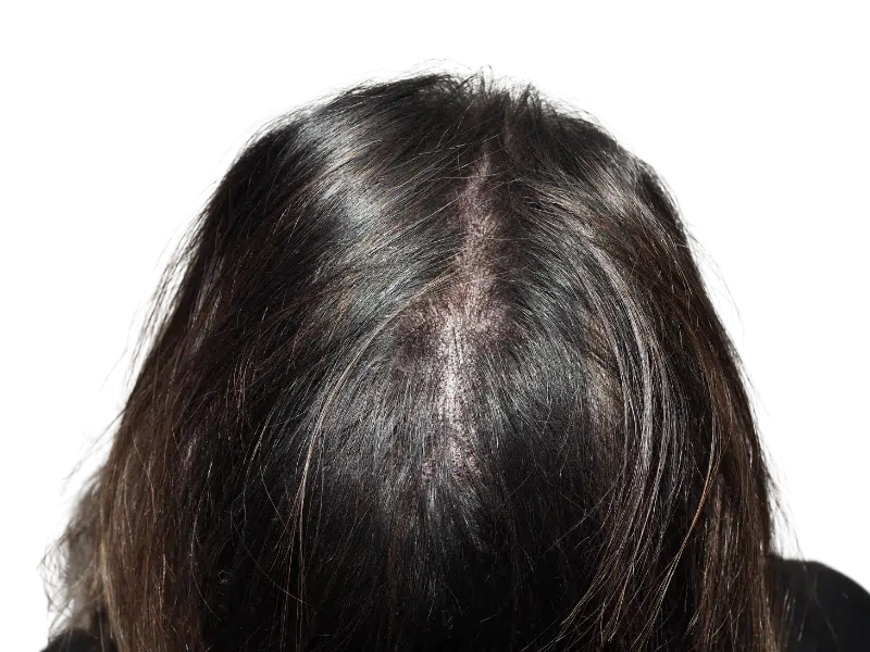 Thinning dark brown hair, visible scalp. Potential hair loss candidate. Consider hair restoration options.